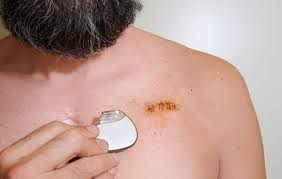 What Is a Pacemaker?