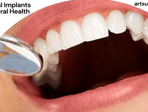 How Dental Implants Improve Oral Health