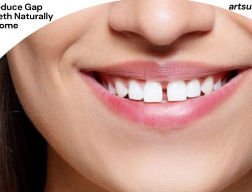 How to Reduce Gap Between Teeth Naturally at Home